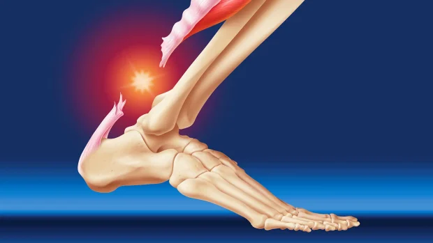 2 Different Types of Tendon Tears and How to Treat Them 2 Different Types of Tendon Tears and How to Treat Them