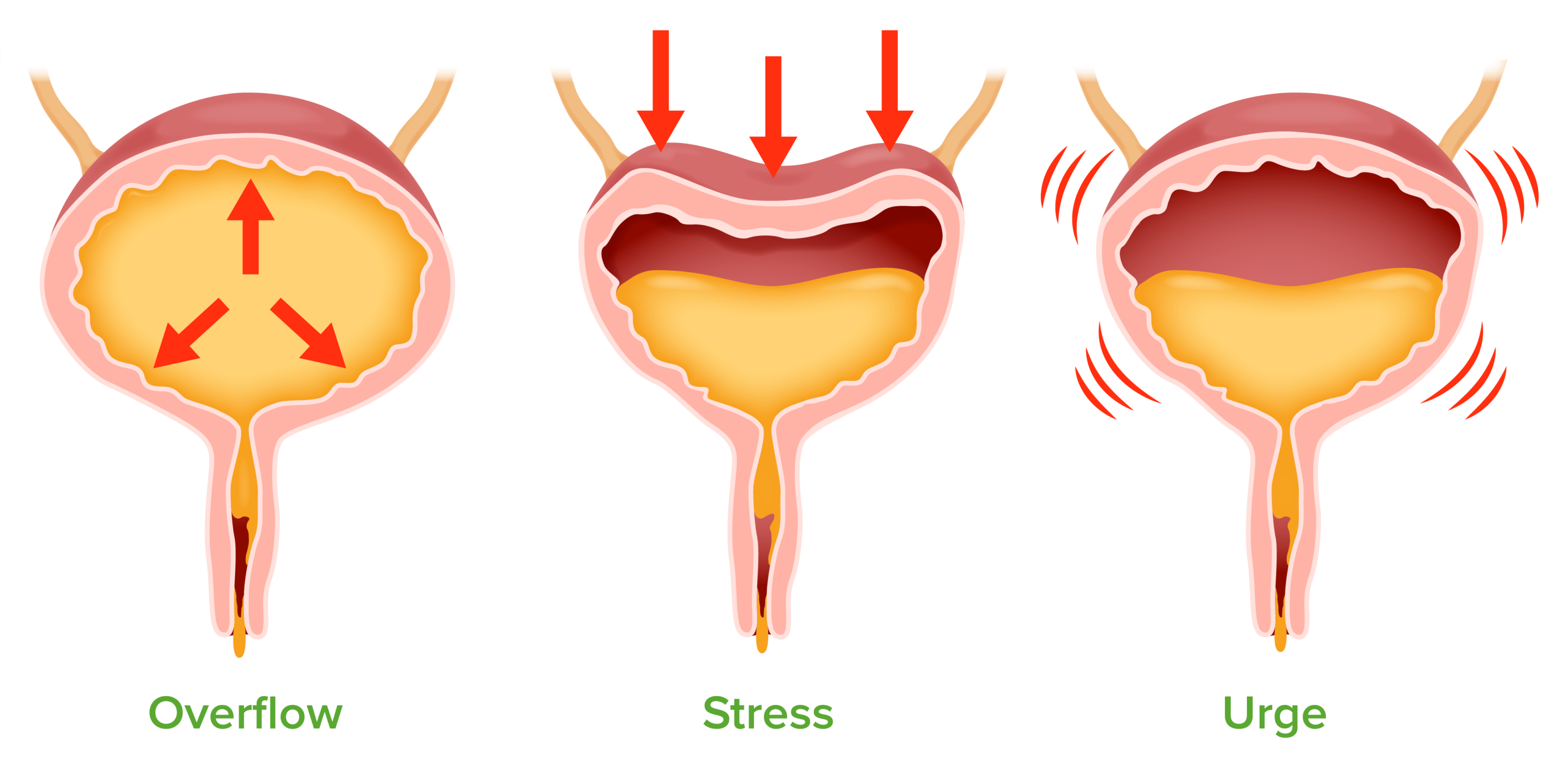 4-tips-for-living-well-with-incontinence-get-healthy-lifestyles