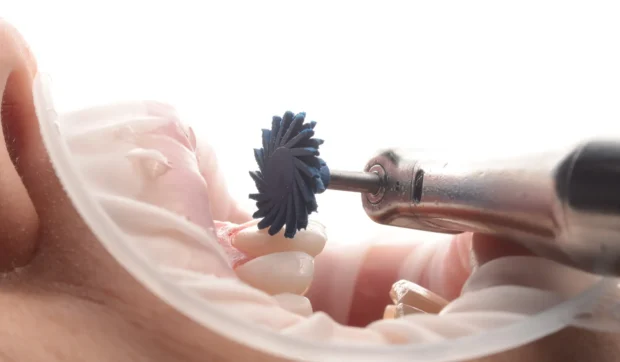 How High-Quality Finishing Enhances the Dental Patient Experience How High-Quality Finishing Enhances the Dental Patient Experience