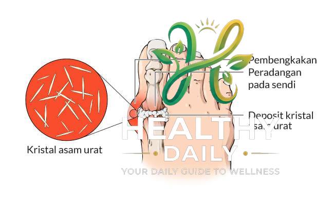 Asam Urat, Panduan Lengkap Mengatasi dan Mencegah Kambuhnya Nyeri Sendi